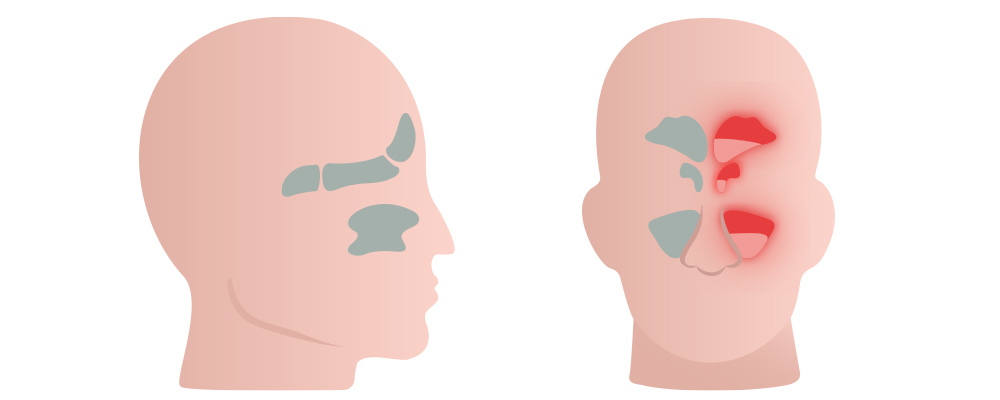 Sinusite | Les maladies de A à Z | Medgate