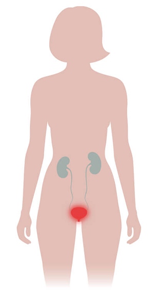 Cystite | Les maladies de A à Z | Medgate